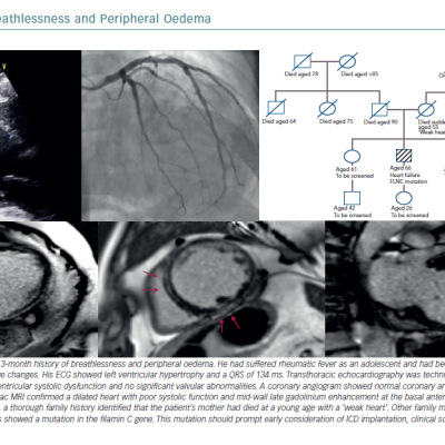 A Case of Breathlessness and Peripheral Oedema