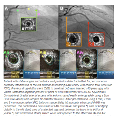 Chronic Total Occlusion of Left Anterior Descending Artery Secondary to Stent Failure