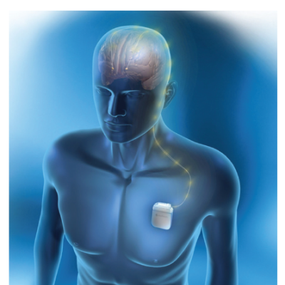 Deep Brain Stimulation Device