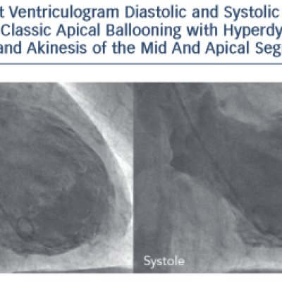 Left Ventriculogram Diastolic