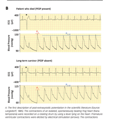 Figure 1 Post-extrasystolic Potentiation