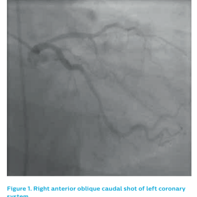 Figure 1. Right anterior oblique caudal shot of left coronarybr /
system