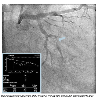 Sub occlusive Lesion in Marginal Branch