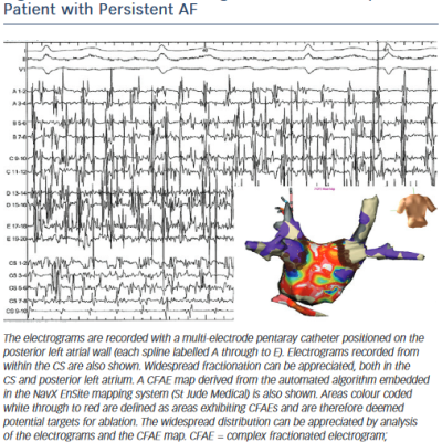 Intracardiac Electrograms and CFAE