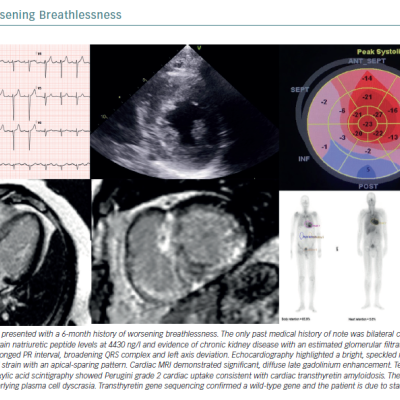 A Case of Worsening Breathlessness