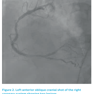 Figure 2. Left anterior oblique cranial shot of the rightbr /
coronary system showing two lesions