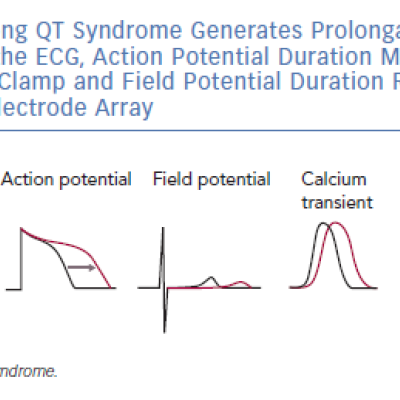 Long QT Syndrome Generates Prolongation of QT Interval at the ECG