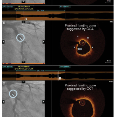 OCT Images Before Scaffold Implantation