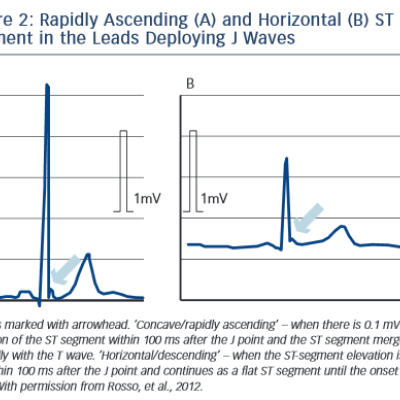 Figure 2 Rapidly Ascending A and Horizontal B ST&ampltbr /&ampgt&amp10Segment in the Leads Deploying J Waves