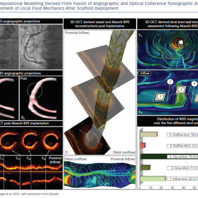 Computational Modelling Derived From Fusion of Angiographic and Optical Coherence Tomographic Acquisitions&ampltbr /&ampgt&amp10for the Assessment of Local Fluid Mechanics After Scaffold Deployment