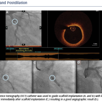 Scaffold Implantation and Postdilation