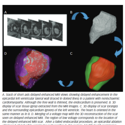 Figure 3 Delayed Enhanced MRI of an Epicardial Scar