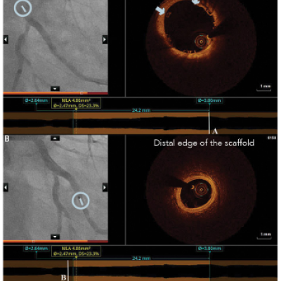 Postinterventional OCT Images