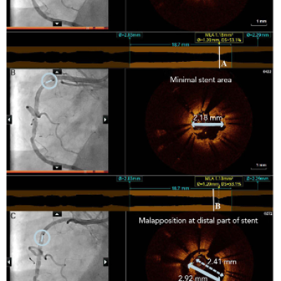 Co registered OCT Images within the Stented Segment