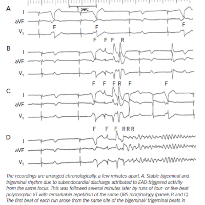 ECG Recordings from an In Vivo Canine Anthopleurin-A Surrogate Model of Long QT Syndrome Type 3