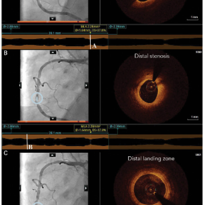 Co registered OCT Images Downstream of the Stented Segment