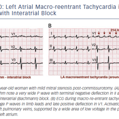 Figure 10 Left Atrial Macro-reentrant Tachycardia in a Patient with Interatrial Block