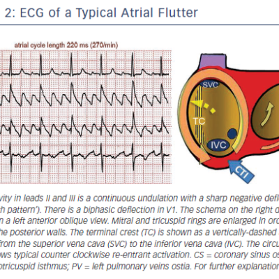 Figure 2 ECG of a Typical Atrial Flutter