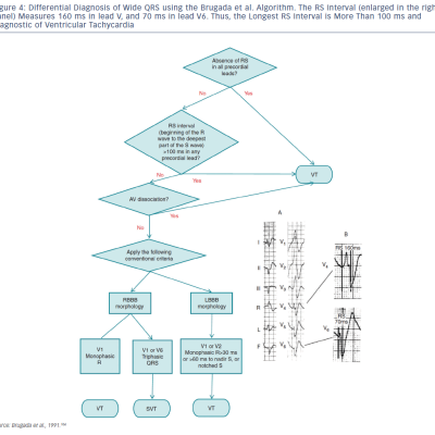 Figure 4 Differential Diagnosis of Wide QRS using the Brugada et al. Algorithm