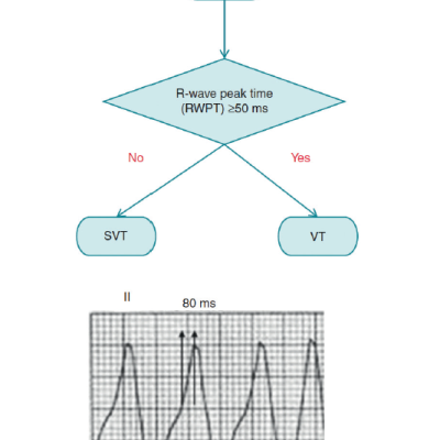 Figure 6 Measurement of the R-wave Peak Time RWPT in Lead II