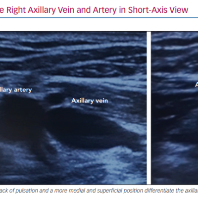2D Ultrasound Image of the Right Axillary Vein and Artery in Short-Axis View