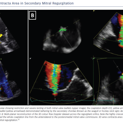 Figure 1 3D Vena Contracta Area in Secondary Mitral Regurgitation