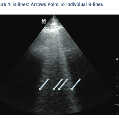 Point to Individual B-Lines