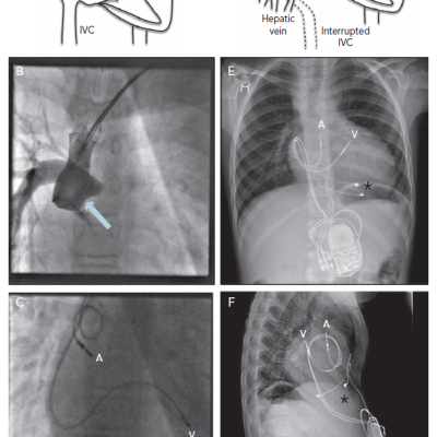 figure 1-Pacing-Solutions-in-Patients