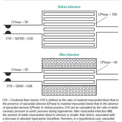 View Image of Coronary Stenosis and its Dependent Myocardium