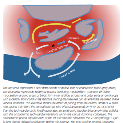 Figure 1 A Figure-of-eight Model of a Typical Scar-related Ventricular Tachycardia Circuit