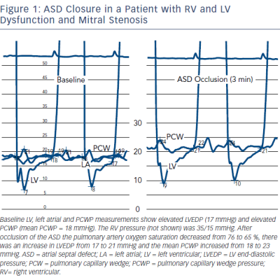 figure 1-asd-closure-in-a-patient