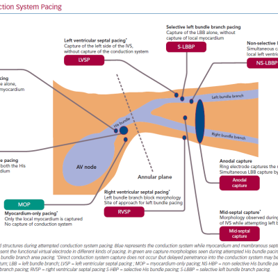 Conduction System Pacing