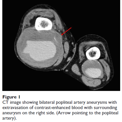 figure 1-ct-image-showing-bilateral