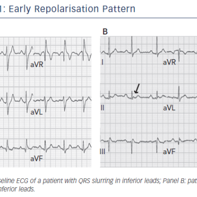 Figure 1 Early Repolarisation Pattern