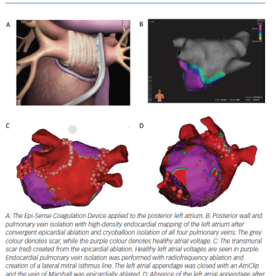 Epicardial and Endocardial Lesions of the Convergent Procedure