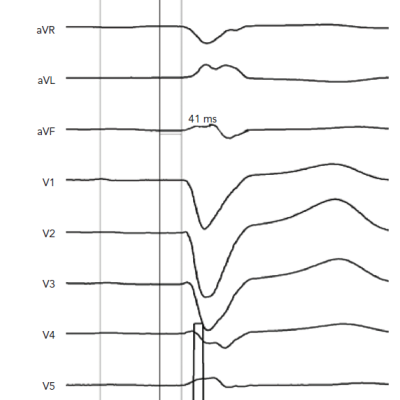 Example of Results of an Electrophysiological Study