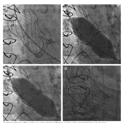 Fluoroscopic Images of the Stages of Valve-in-valve