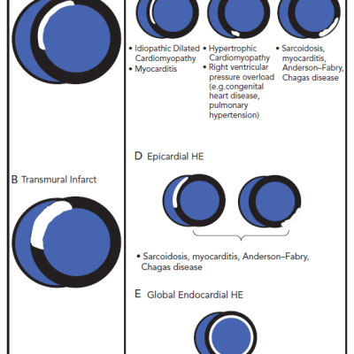 Figure 1 Late Gadolinium Enhancement Patterns in Ischemic and Non-ischaemic Cardiomyopathies