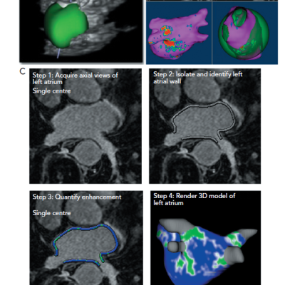 Left Atrial Imaging