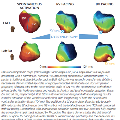 Figure 1 Mapping of Ventricular Electrical Activation