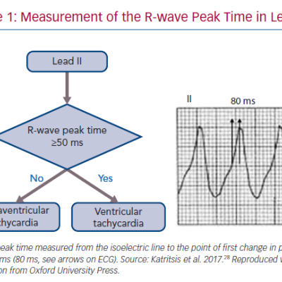 Measurement of the R-wave Peak Time in Lead II