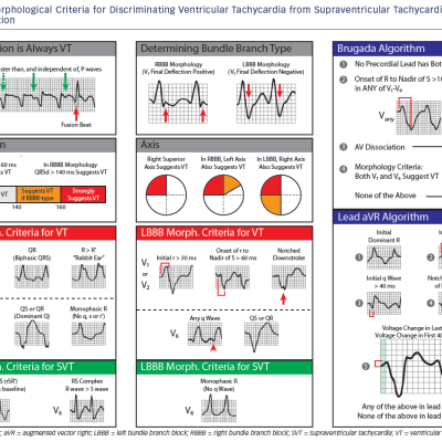 Figure 1 Morphological Criteria for Discriminating Ventricular Tachycardia from Supraventricular Tachycardia with Aberration