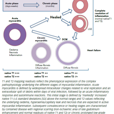 Figure 1 Natural Course Of Myocarditis As Seen By Cardiovascular Magnetic Resonance Using Quantitative Techniques And Late Gadolinium Enhancement