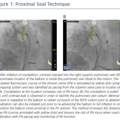 Figure 1 Proximal Seal Technique