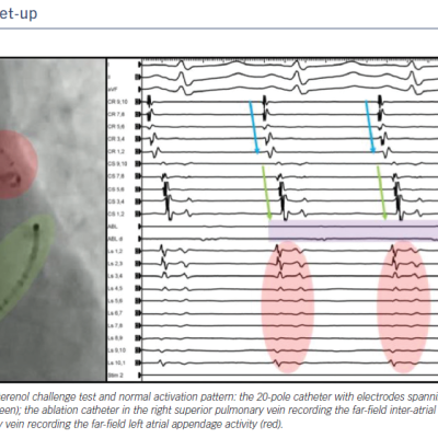 Standard Catheter Set-up