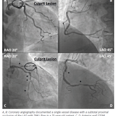 Figure 1 STEMI of the Anterior Wall Single Vessel Disease and Multivessel Disease