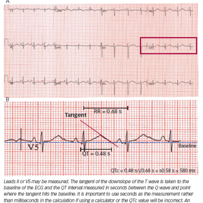 Tangent Method of QTc Measurement