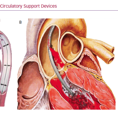 Temporary Mechanical Circulatory Support Devices
