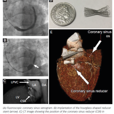 Figure 1 The Coronary Sinus Reducer