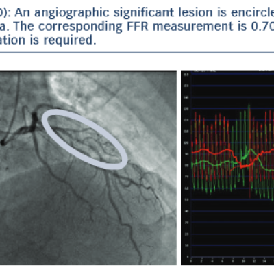 Left Anterior Descending LAD